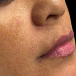 Lip Filler Before & After Patient #11585