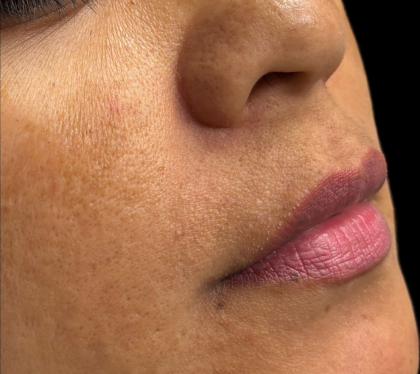 Lip Filler Before & After Patient #11585