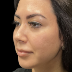 Cheek Filler Before & After Patient #11580