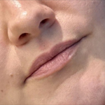 Lip Filler Before & After Patient #11582