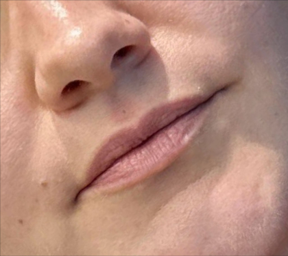 Lip Filler Before & After Patient #11582