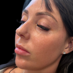 Lip Filler Before & After Patient #11575
