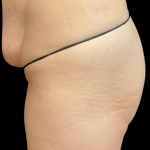 Brazilian Butt Lift Before & After Patient #11596