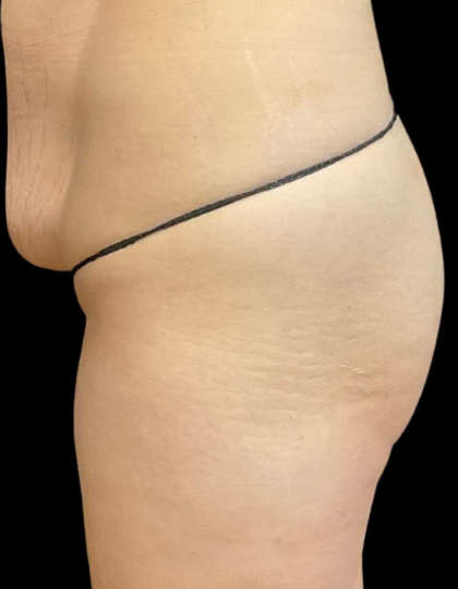 Brazilian Butt Lift Before & After Patient #11596