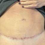 Morpheus8 Before & After Patient #11589