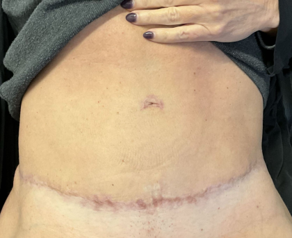Morpheus8 Before & After Patient #11589