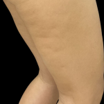 Vivace Before & After Patient #11584