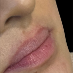 Lip Filler Before & After Patient #11576