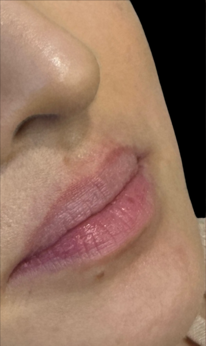 Lip Filler Before & After Patient #11576