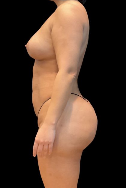 Brazilian Butt Lift Before & After Patient #11541