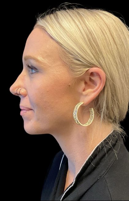 Sofwave Before & After Patient #11567