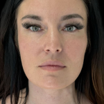 AVAVA Laser Before & After Patient #11573