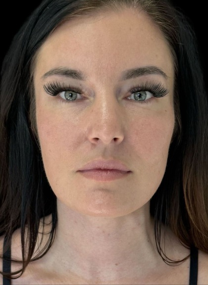 AVAVA Laser Before & After Patient #11573