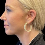 Sculptra Before & After Patient #11581