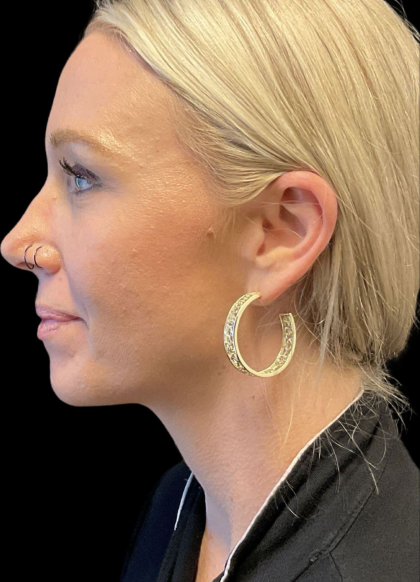 Sculptra Before & After Patient #11581