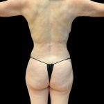 Rib Repositioning Before & After Patient #11578
