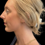 Chin Filler Before & After Patient #11586