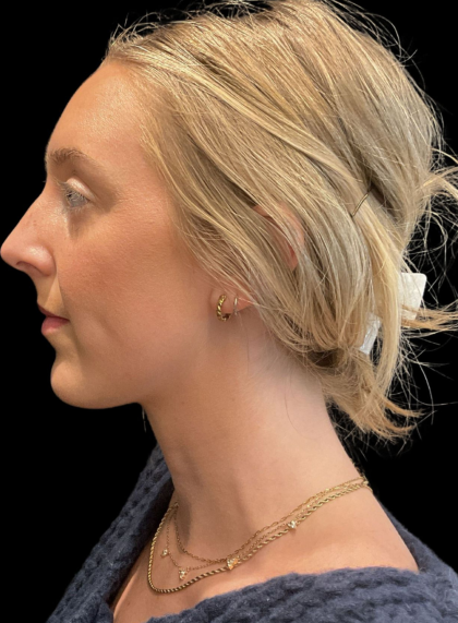 Chin Filler Before & After Patient #11586