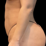 Brazilian Butt Lift Before & After Patient #11591