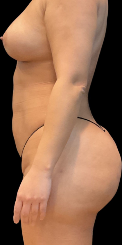 Brazilian Butt Lift Before & After Patient #11591