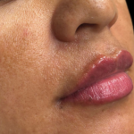 Lip Filler Before & After Patient #11585
