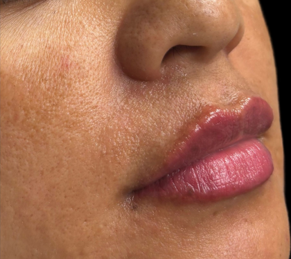 Lip Filler Before & After Patient #11585
