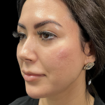 Cheek Filler Before & After Patient #11580