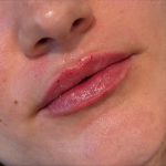 Lip Filler Before & After Patient #11582