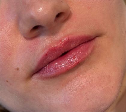 Lip Filler Before & After Patient #11582