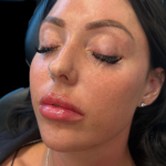 Lip Filler Before & After Patient #11575