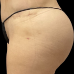 Brazilian Butt Lift Before & After Patient #11596