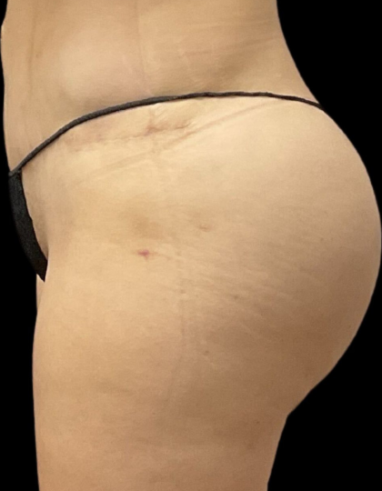 Brazilian Butt Lift Before & After Patient #11596