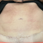 Morpheus8 Before & After Patient #11589