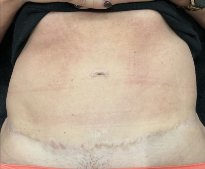 Morpheus8 Before & After Patient #11589