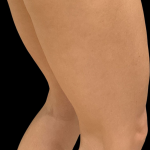 Vivace Before & After Patient #11584