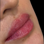 Lip Filler Before & After Patient #11576