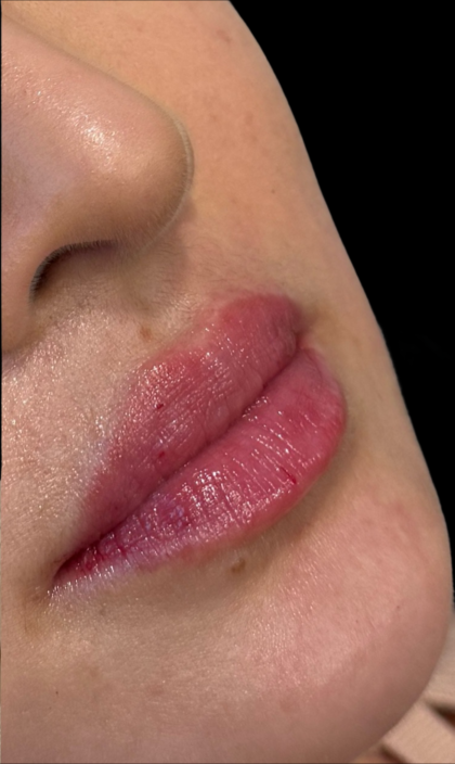 Lip Filler Before & After Patient #11576