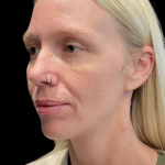 Sculptra Before & After Patient #11581