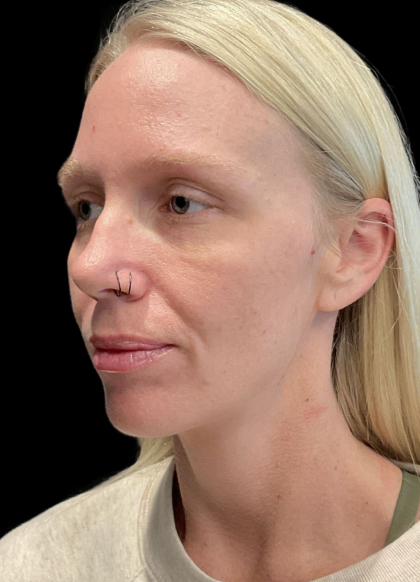 Sculptra Before & After Patient #11581