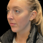 Chin Filler Before & After Patient #11586