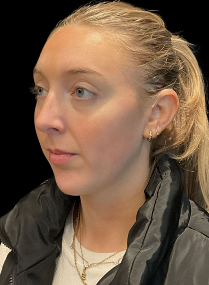 Chin Filler Before & After Patient #11586