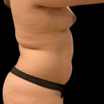 Brazilian Butt Lift Before & After Patient #11579