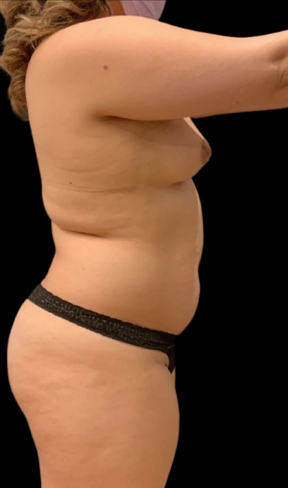 Brazilian Butt Lift Before & After Patient #11579