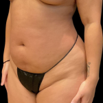 Brazilian Butt Lift Before & After Patient #11591
