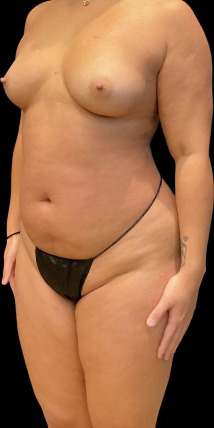 Brazilian Butt Lift Before & After Patient #11591