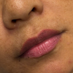 Lip Filler Before & After Patient #11585