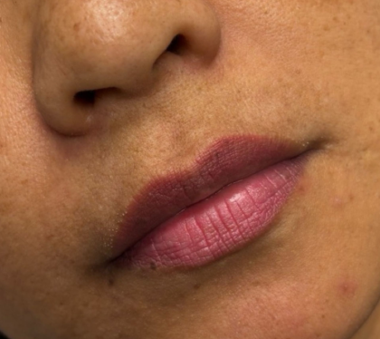 Lip Filler Before & After Patient #11585