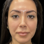 Cheek Filler Before & After Patient #11580