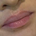 Lip Filler Before & After Patient #11576