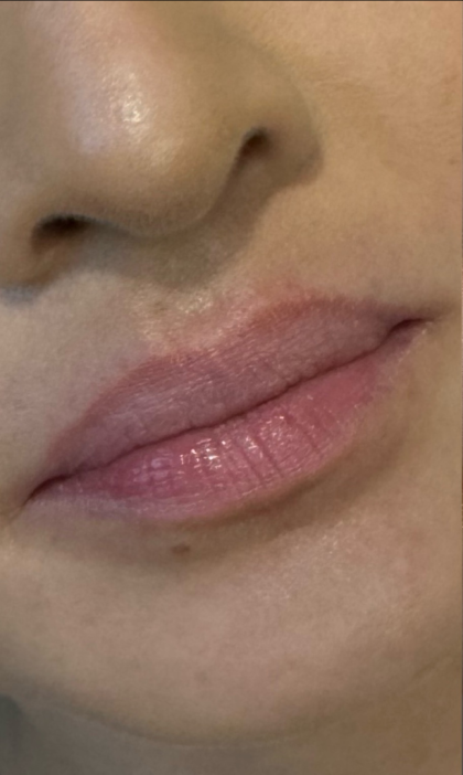 Lip Filler Before & After Patient #11576